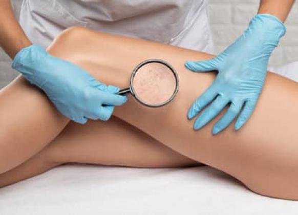 venous-disease