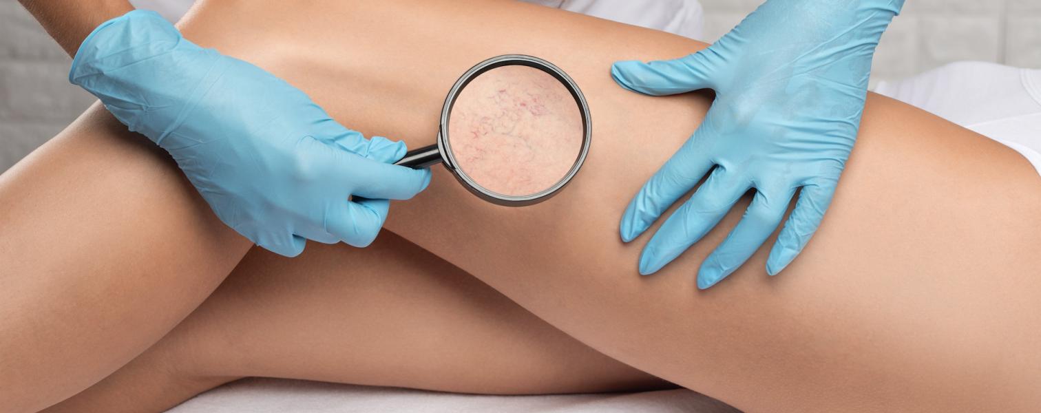 venous-disease