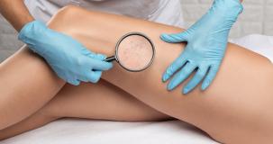 venous-disease