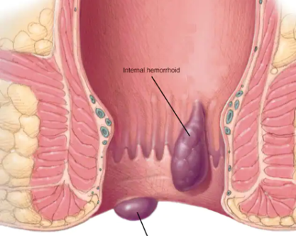 internal hemorroids
